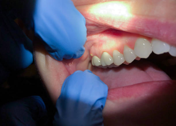 Best Emergency Treatment for Dental Infections or Abscesses in Fortuna, CA